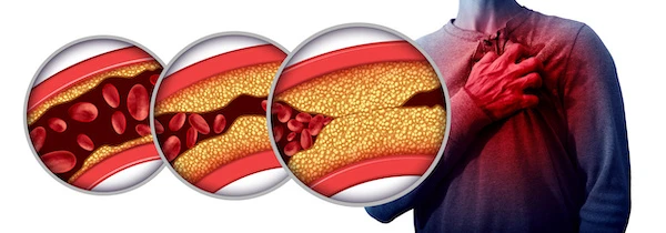 Zvýšený cholesterol a srdcová bolest