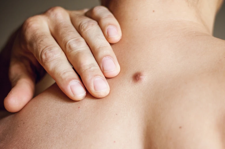 Ruce dotýká hnědého dermatofibromu na zádech.