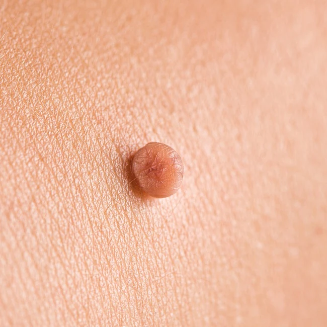 Přibližný pohled na dermatofibrokom na lidské kůži.