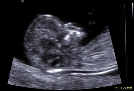 Ultrazvukové vyšetření plodu pro měření tloušťky krku.