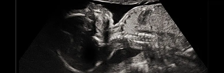 Ultrazvukový snímek plodu s viditelnou tváří a lebkou.