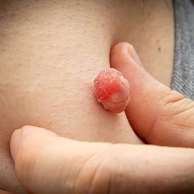 Růžový dermatofibrom na lidské kůži ukazuje prst.