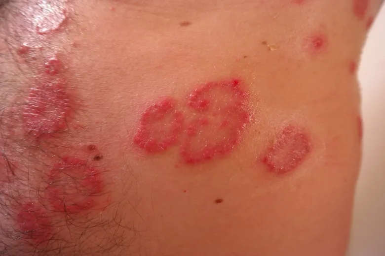 Červené šupinaté skvrny na kůži typické pro začínající lupénku.