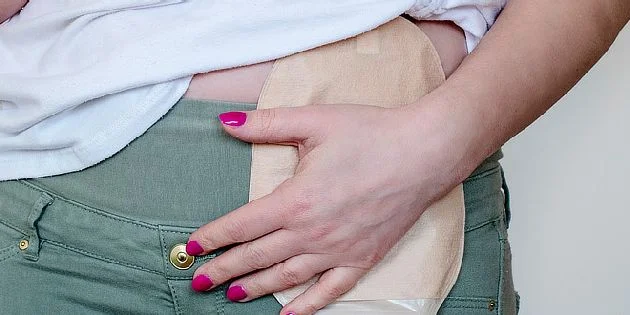 Colostomy bag on hand