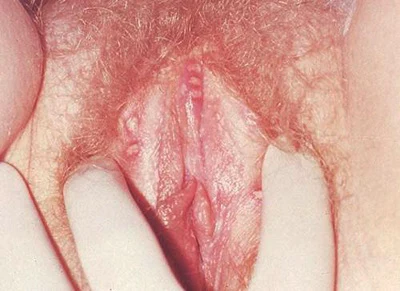 Vulva with inflammation