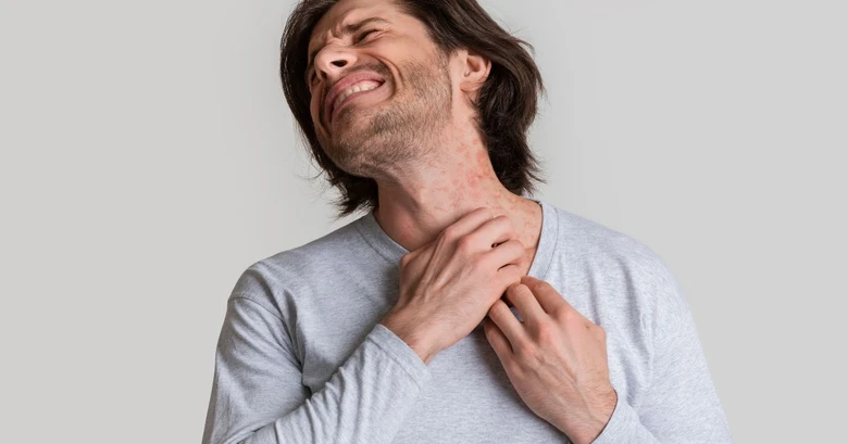 Man with rash on neck and chest