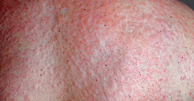 Viral rash on skin