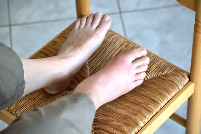 Swollen foot on chair