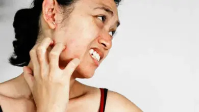 Woman scratching skin rash