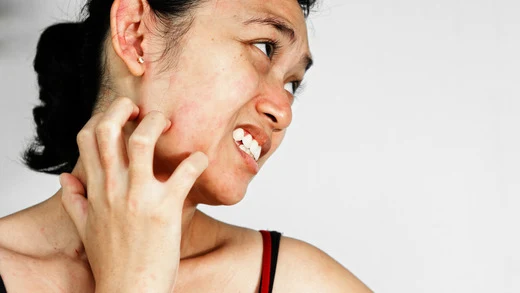 Woman scratching skin rash