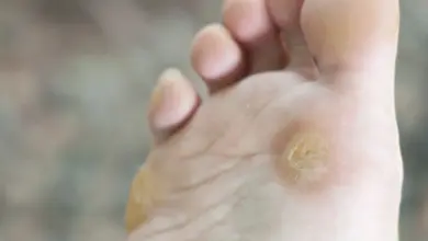 Foot warts on sole