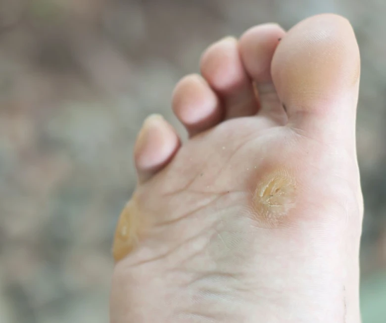 Foot warts on sole
