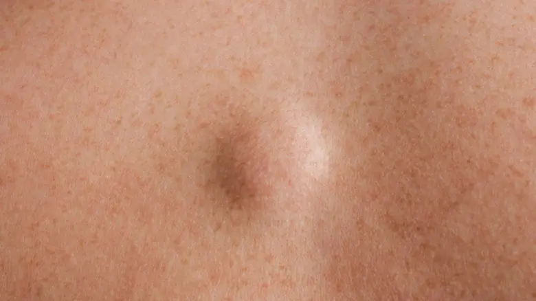 Zvětšený pohled na kožní pupínek nebo uzlík na kůži.