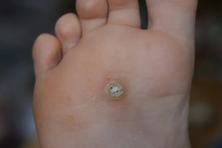 Plantární bradavice na patě nohy s viditelným tvrdším povrchem.