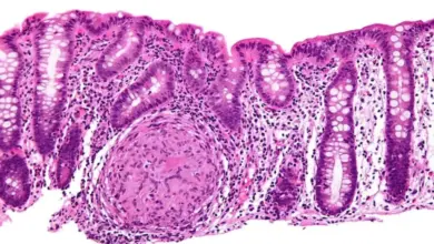 Histologický snímek střeva s granulomem při Crohnově chorobě.
