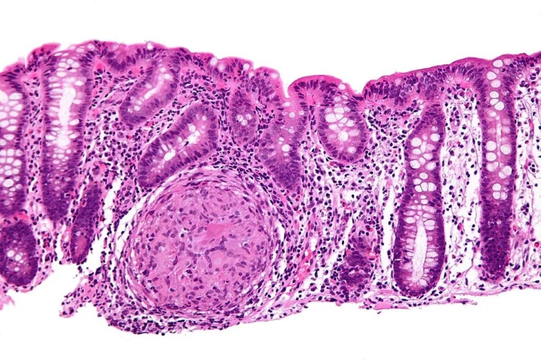 Histologický snímek střeva s granulomem při Crohnově chorobě.