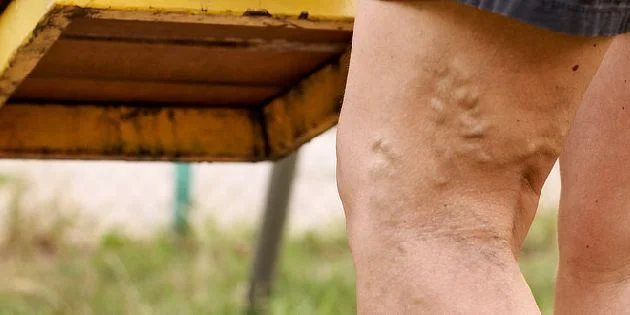 Zvětšené žíly na lidském stehně ukazující problém s cévami.