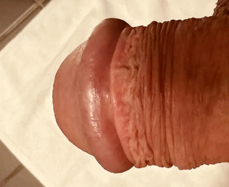 Penis s drobnými pupínky na povrchu kůže.