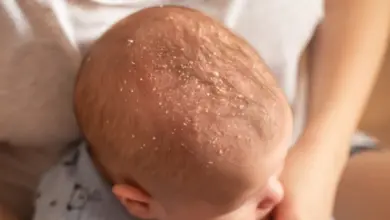 Babič s bílými šupinami na hlavě typickými pro seboreu.