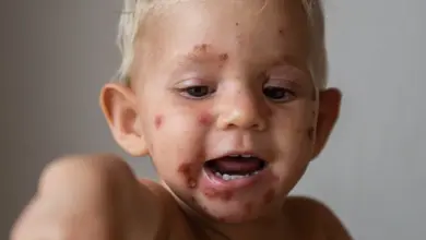 Malý dítě s typickými vředy a kůrou na tváři při impetigu.