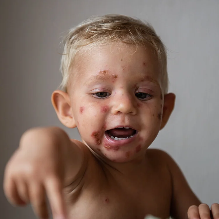 Malý dítě s typickými vředy a kůrou na tváři při impetigu.