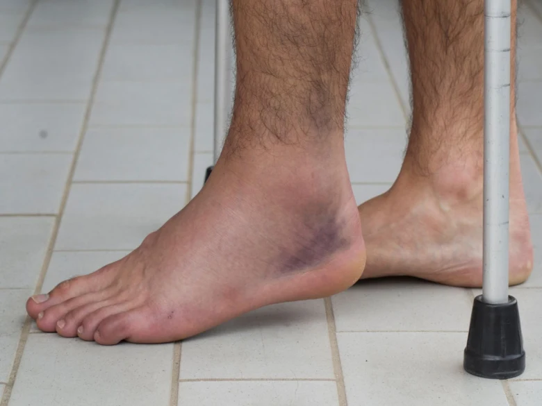 Injured ankle with bruise and crutch