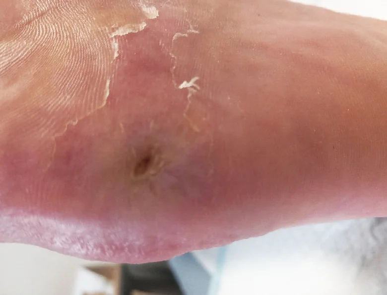 Otevřená rána na noze diabetika s příznaky infekce.