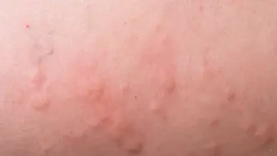 Zvýšené červené pupínky na kůži dítěte s kopřivkou.