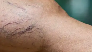 Zvětšený pohled na žilní síť s výraznými rozšířenými žilkami.