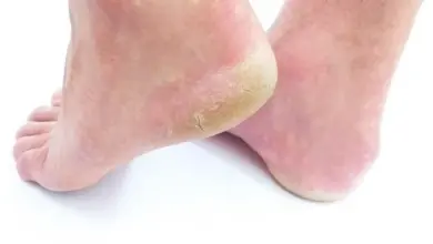 Diabetická noha s suchou kůží na patách