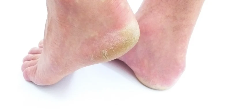 Diabetická noha s suchou kůží na patách