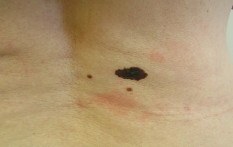 Dark skin lesion with satellite spots