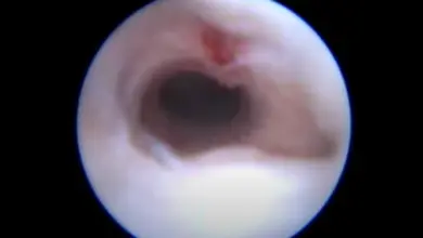 Nasal polyp endoscopy view