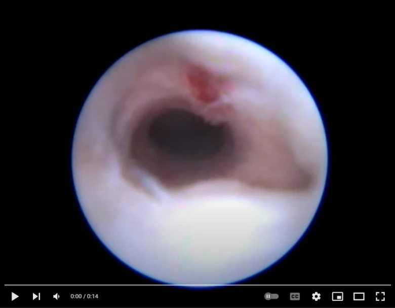 Nasal polyp endoscopy view