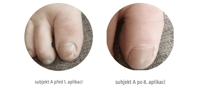 Porovnání nehtu na palci před léčbou mykózou a po osmých aplikacích.