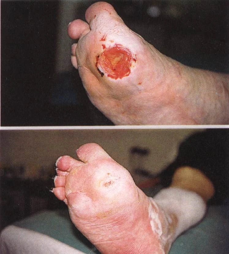 Diabetická rána na noze před a po léčbě s hojením.