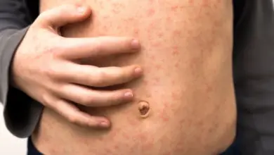 Červený svědivý vyrážka na kůži těla s rukou dotýkající se pupíků.