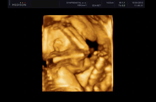 3d ultrasound fetus