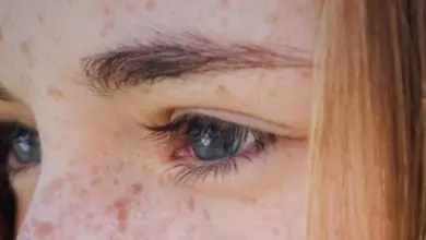 Žena s jaterními skvrnami na obličeji v detailu.